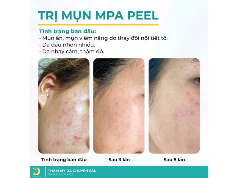 Các phương pháp điều trị mụn tại clinic hiện nay