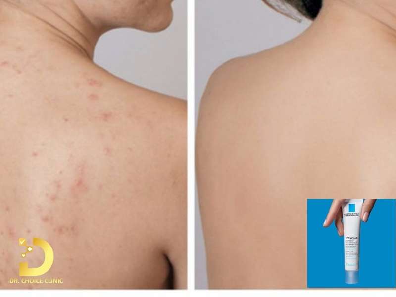 Sử dụng thuốc bôi không kê đơn để kiểm soát mụn