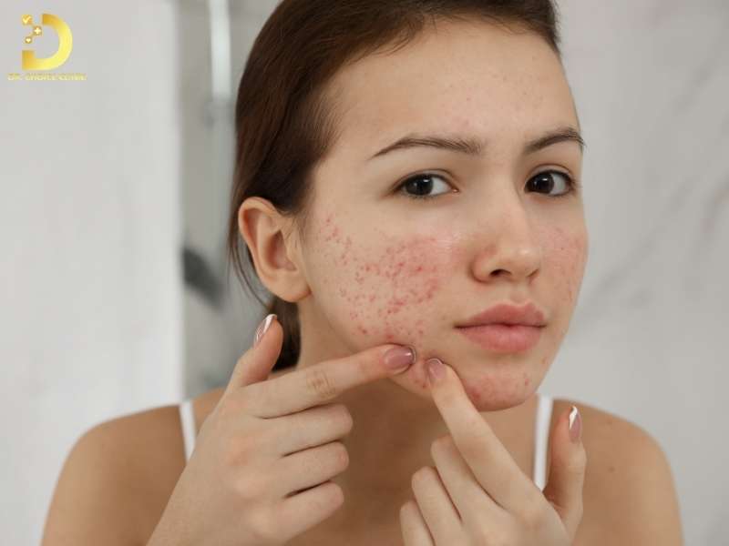 Hiểu đúng về da mụn để skincare không phản tác dụng