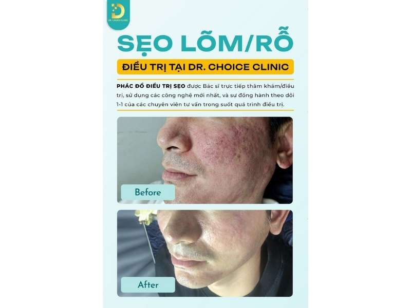 Kết quả điều trị sẹo lõm Dr. Choice Clinic.