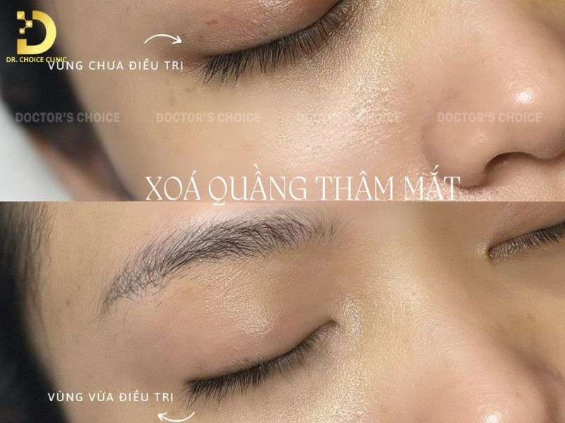 Thâm Mắt Do Đâu? Các Loại Thâm Mắt & Cách Điều Trị Hiệu Quả Tại Nhà 13 Điều trị thâm mắt ở đâu an toàn, hiệu quả tại HCM?