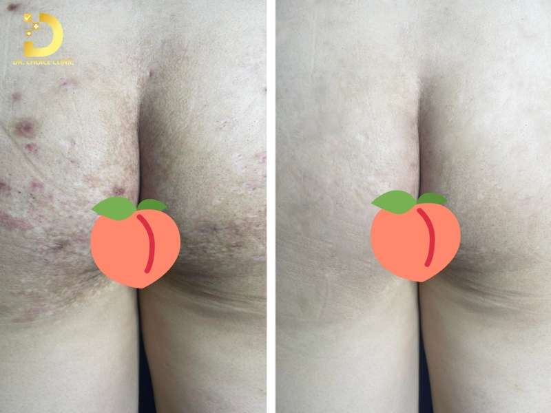 Kết quả điều trị thâm mông tại Dr. Choice Clinic