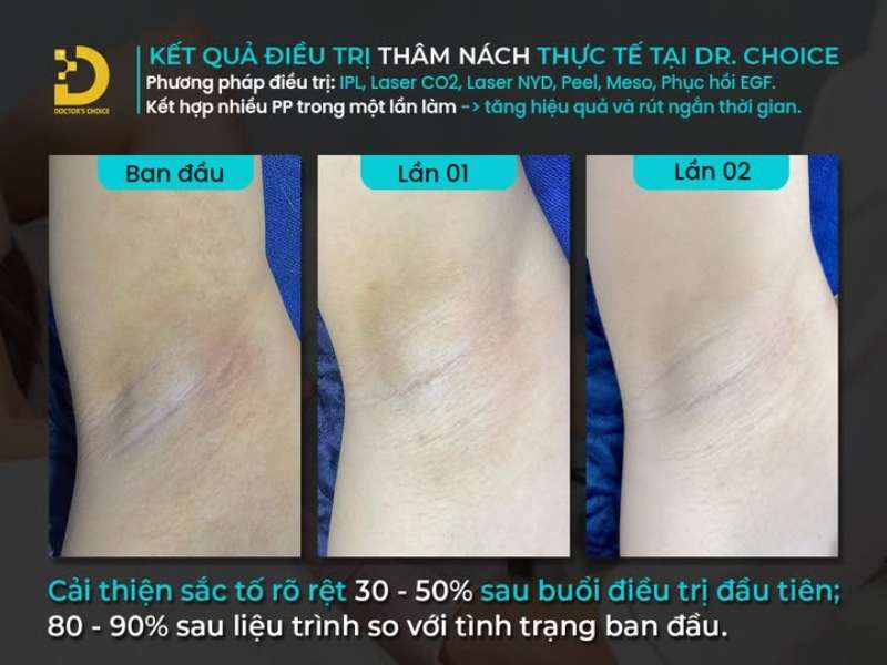 điều trị thâm nách tại Dr. Choice Clinic
