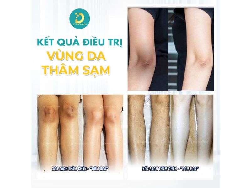 Kết quả điều trị các vùng da thâm sạm.