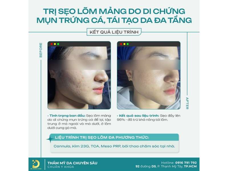 Quy trình điều trị sẹo lõm Dr. Choice Clinic