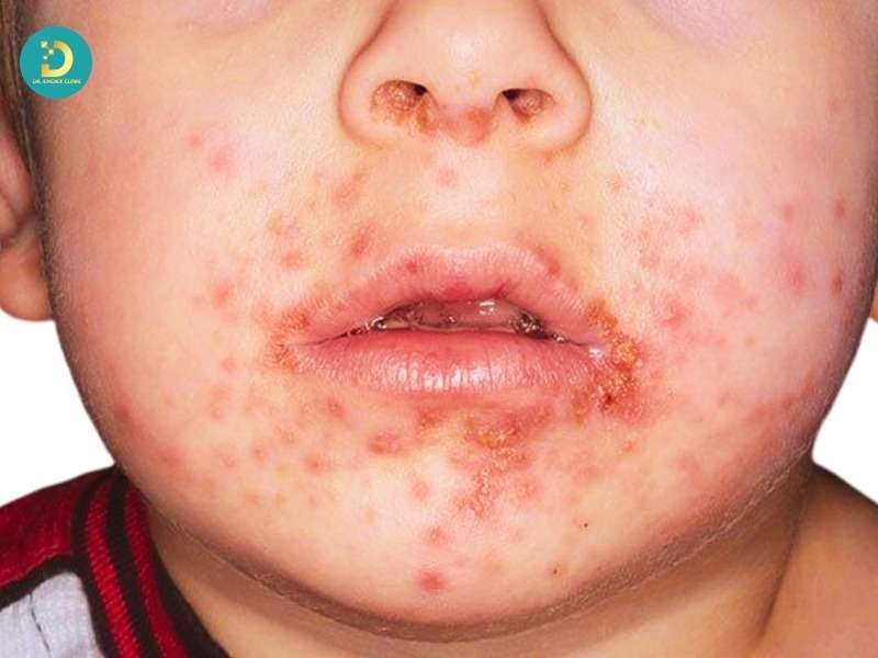 Sùi Mào Gà Trẻ Em: Nguyên Nhân, Dấu Hiệu, Cách Điều Trị & Phòng Ngừa 12 Khi nào cần đưa trẻ đi khám ngay?