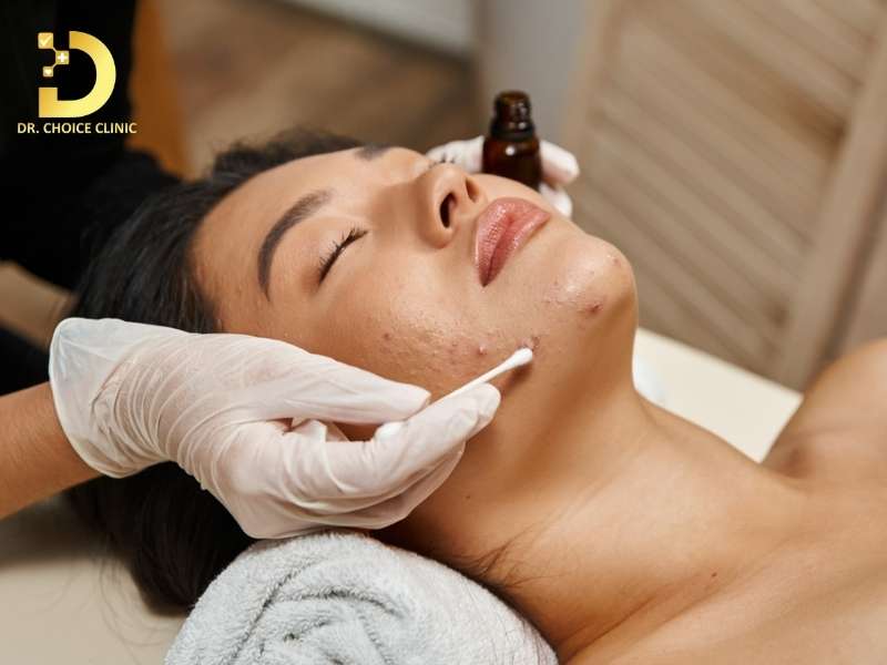 Làm thế nào để điều trị mụn không viêm hiệu quả?