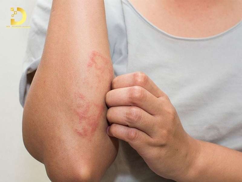 Làm thế nào để điều trị viêm da kích ứng hiệu quả?