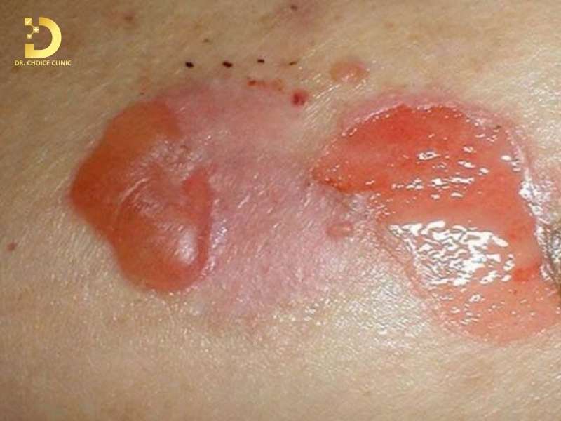 Viêm da kích ứng có lây từ người sang người không?