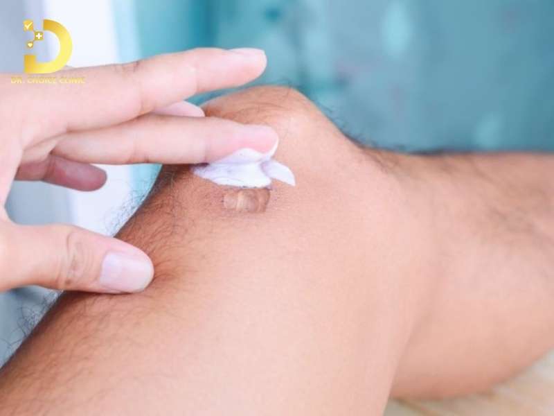 Làm thế nào điều trị sẹo lồi ở đầu gối hiệu quả?