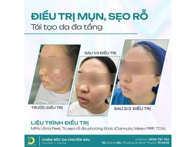 Đơn vị nào điều trị mụn viêm đỏ uy tín, hiệu quả tại Hồ Chí Minh?
