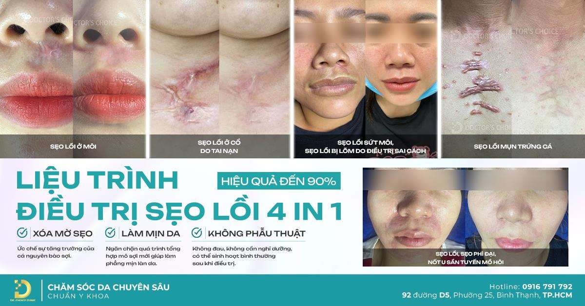 Kết quả điều trị sẹo lồi tại Dr. Choice Clinic
