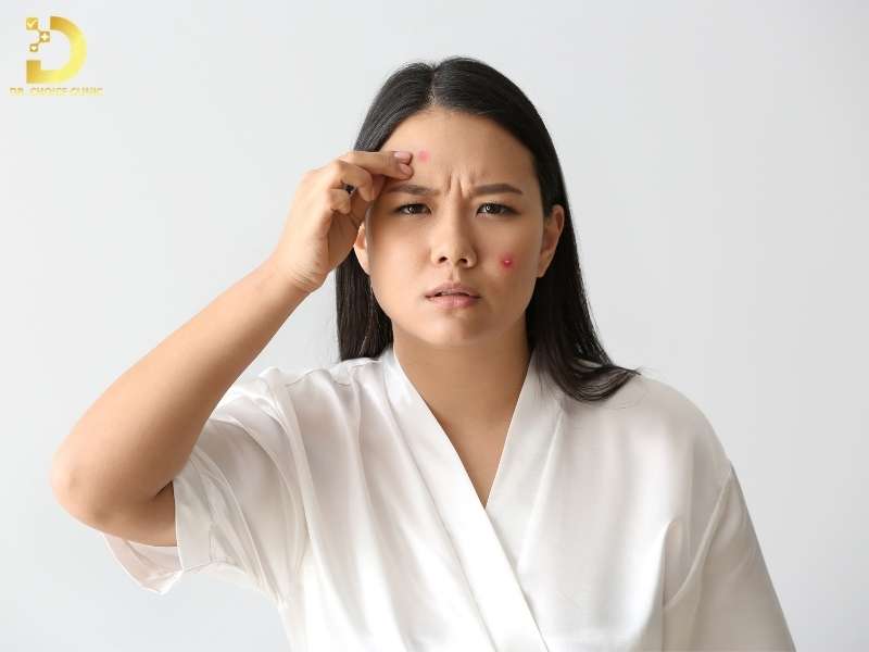 Lưu ý gì khi sử dụng mỹ phẩm cho da mụn?