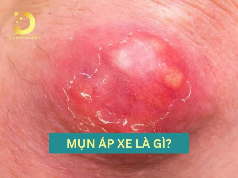 Mụn áp xe là gì? làm thế nào để nhận biết chính xác tình trạng này?