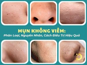 Mụn không viêm