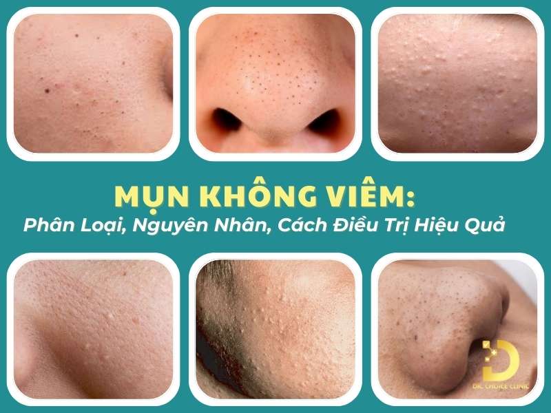 Mụn không viêm