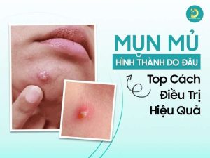 Mụn mủ hình thành do đâu?