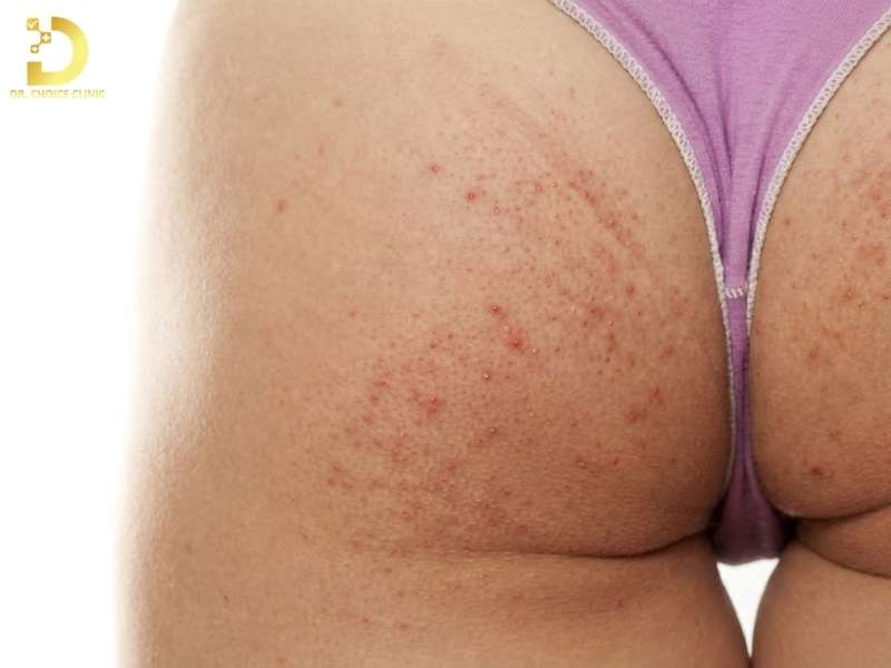 Nội tiết, cơ địa da và yếu tố miễn dịch nền