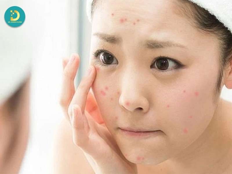 Mụn ở tuổi dậy thì là gì? 