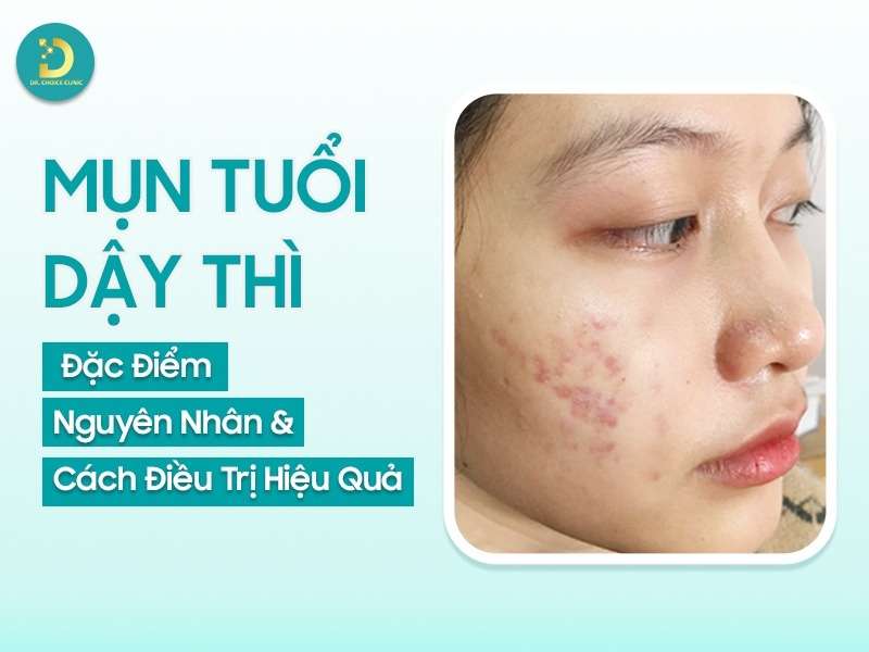 Mụn ở tuổi dậy thì