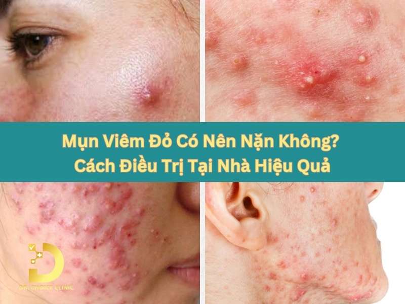 Mụn viêm đỏ có nên nặn không?