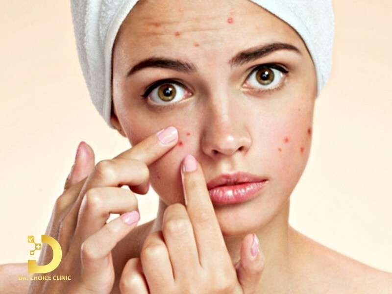 Mụn viêm đỏ là gì?