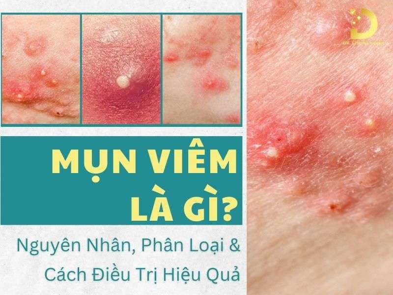 Mụn viêm là gì? 