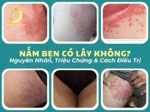 Nấm bẹn có lây không?