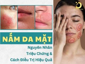 Nấm da mặt