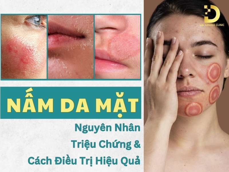 Nấm da mặt