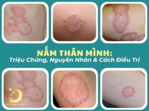 Nấm thân mình