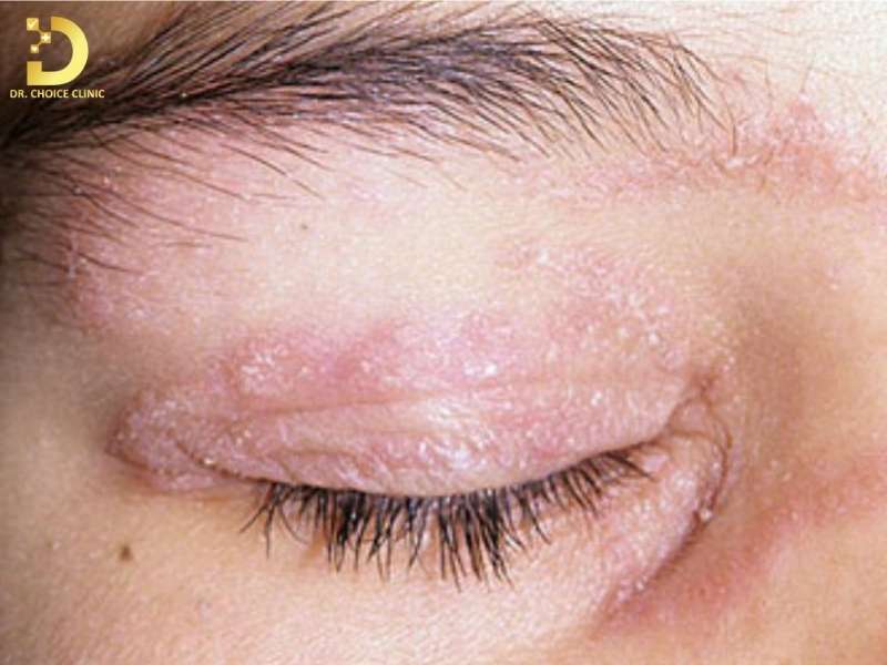 Nguyên nhân hình thành nấm da mặt