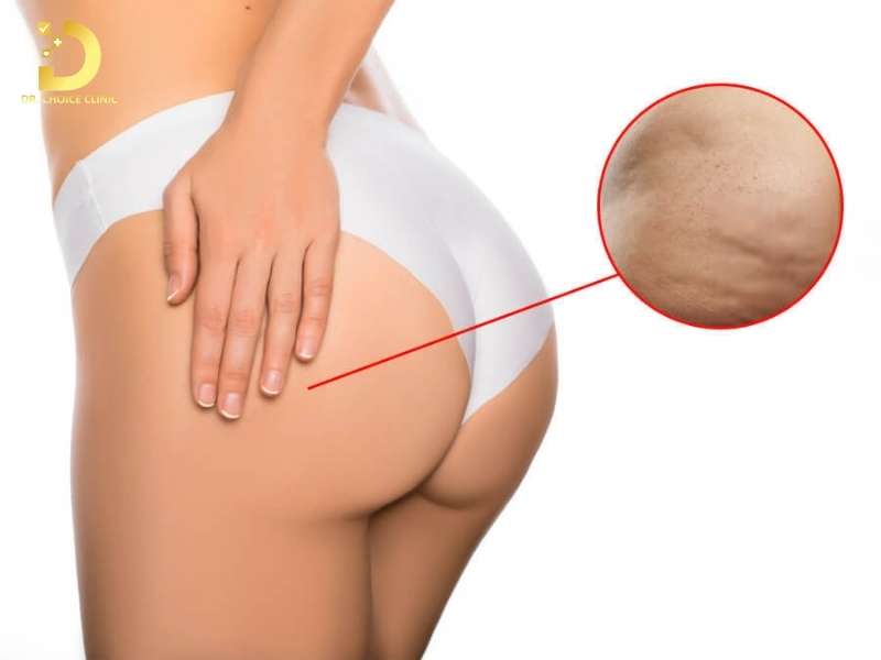 Nguyên nhân sinh lý và thói quen nào dẫn đến tình trạng thâm sạm vùng mông?