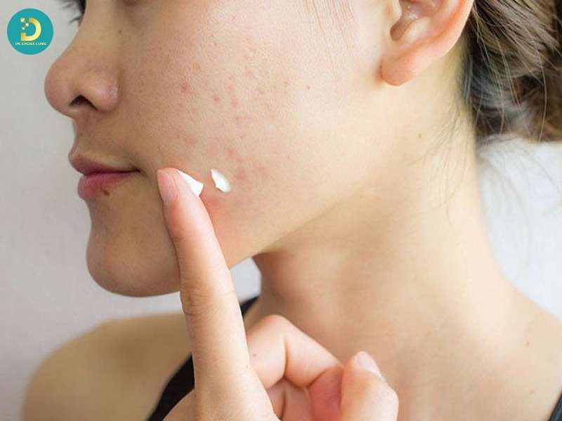 Nhóm trị mụn nội khoa