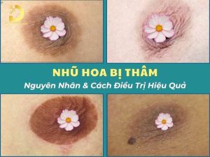 Nhũ hoa bị thâm