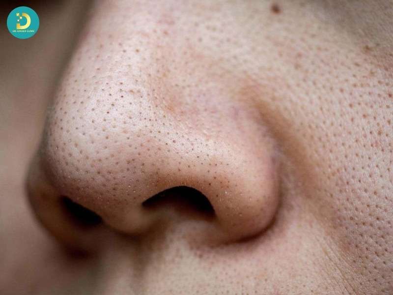 Những loại mụn có thể cải thiện nhờ xông hơi