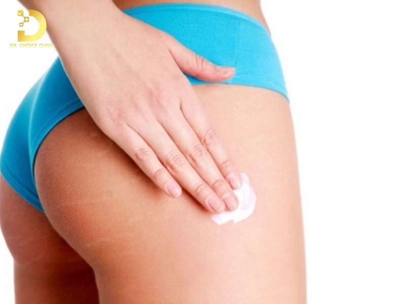 Những sai lầm phổ biến nào khiến việc điều trị thâm mông mãi không có kết quả?