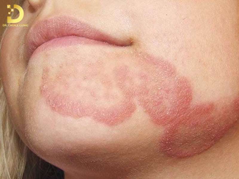 Những sai lầm thường gặp khi điều trị nấm da mặt