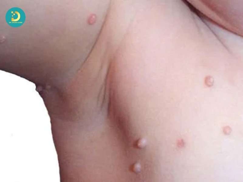 Sùi Mào Gà Trẻ Em: Nguyên Nhân, Dấu Hiệu, Cách Điều Trị & Phòng Ngừa 11 Những yếu tố làm trẻ dễ nhiễm HPV