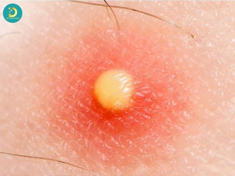 Phân loại mụn mủ