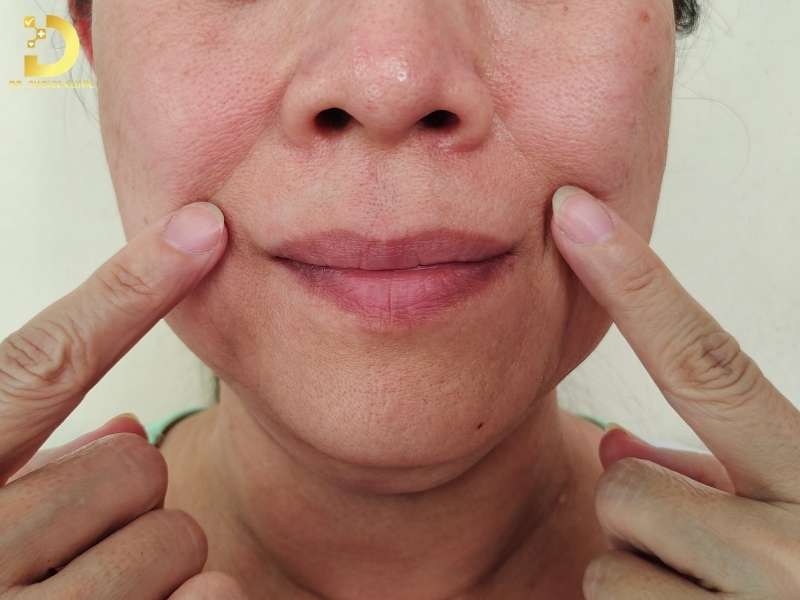 Phân loại rãnh cười như thế nào theo độ sâu?