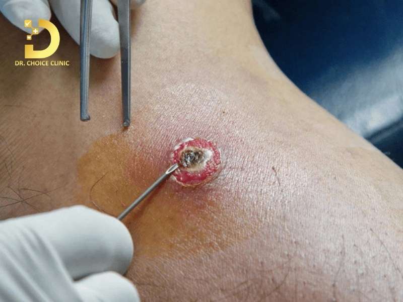 Phương pháp điều trị mụn áp xe nào mang lại hiệu quả cao và an toàn nhất?