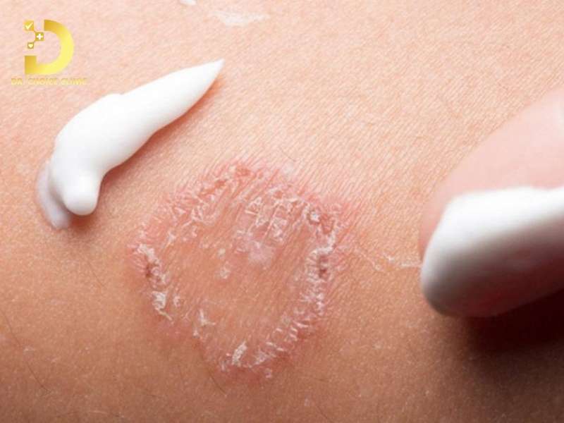 Phương pháp điều trị nấm thân mình nào mang lại hiệu quả tối ưu và an toàn?