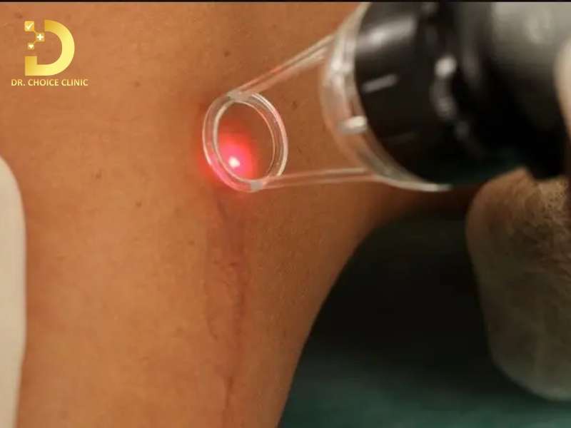 Liệu trình điều trị sẹo lồi 4in1 (Điều trị nội khoa nền tảng)