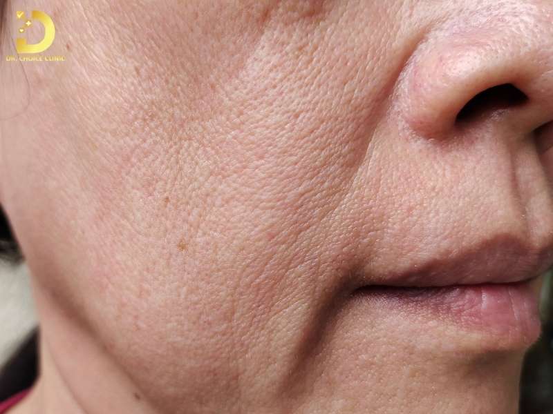 Rãnh cười là gì?