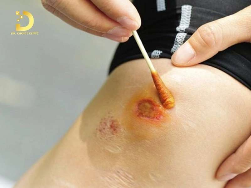 Sai phổ biến nào khiến vết thâm mãi không thuyên giảm? lầm