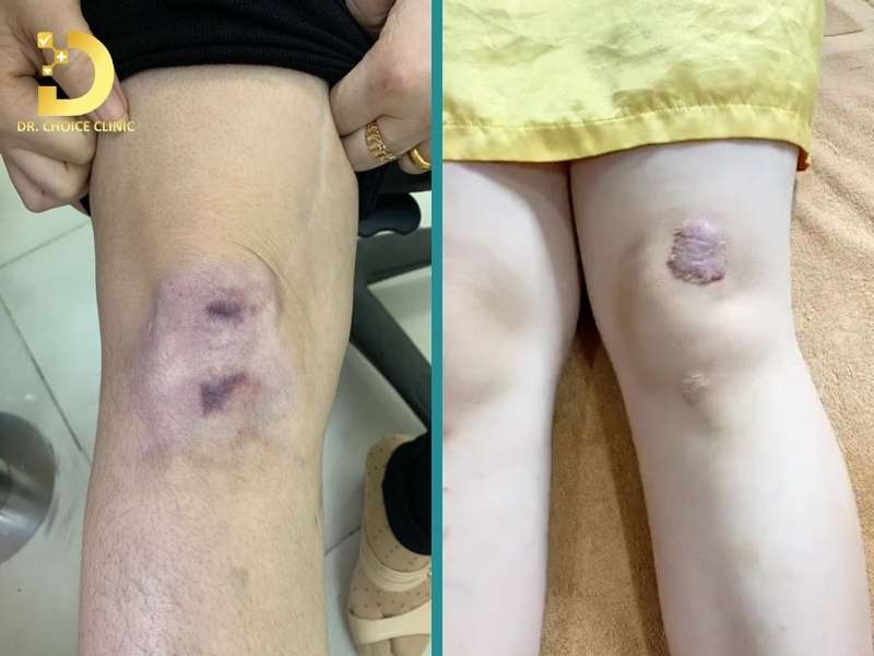 Sẹo lồi ở đầu gối là gì?