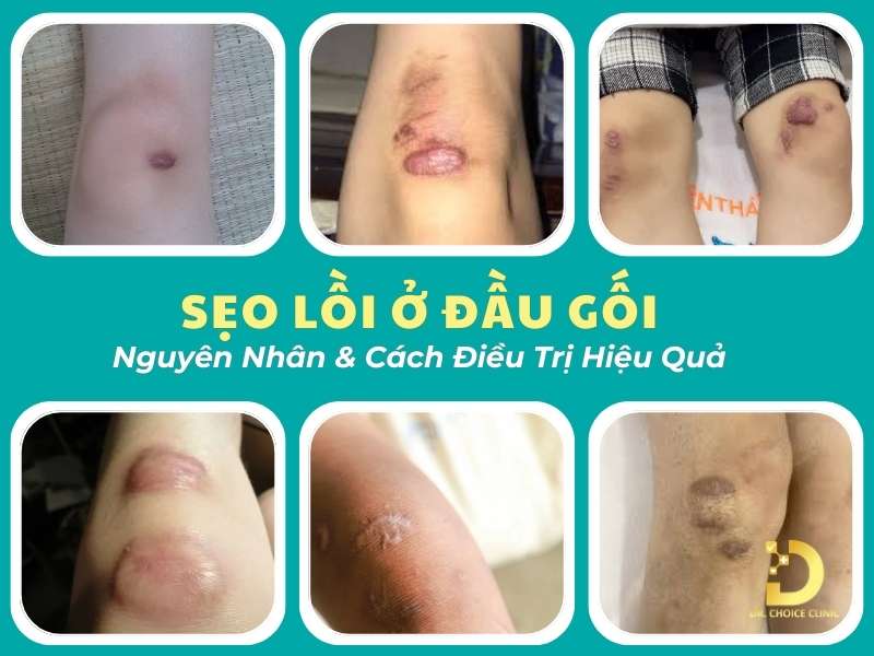 Sẹo lồi ở đầu gối