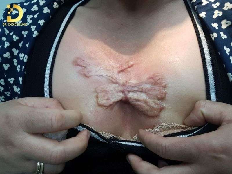 Sẹo Lồi Ở Ngực: Nguyên Nhân & Cách Điều Trị Hiệu Quả 8 Sẹo lồi ở ngực là gì và vì sao vùng ngực dễ hình thành sẹo xấu?