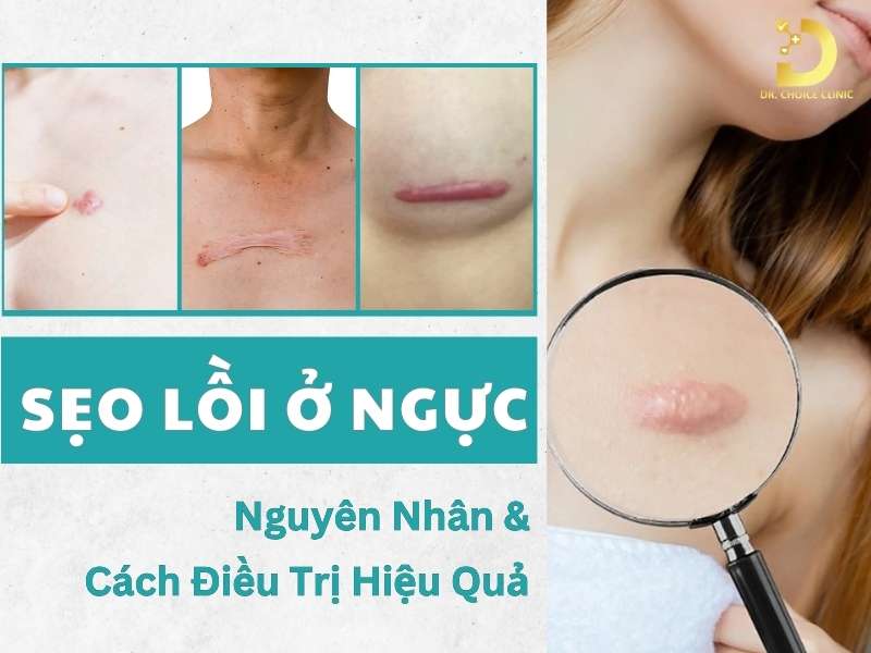 Sẹo Lồi Ở Ngực: Nguyên Nhân & Cách Điều Trị Hiệu Quả 7 Sẹo lồi ở ngực